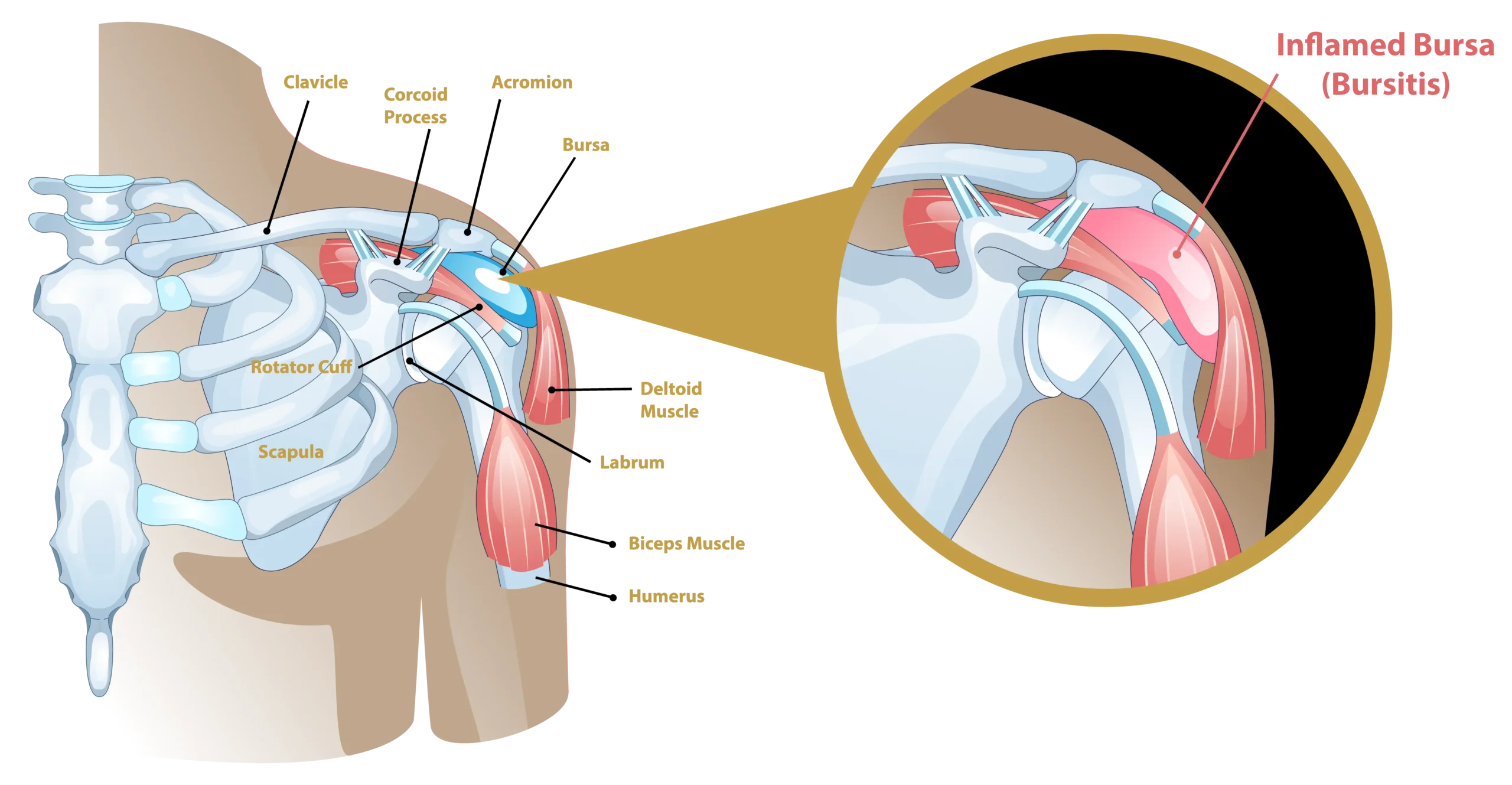 Anatomical Graphic of Shoulder Bursitis