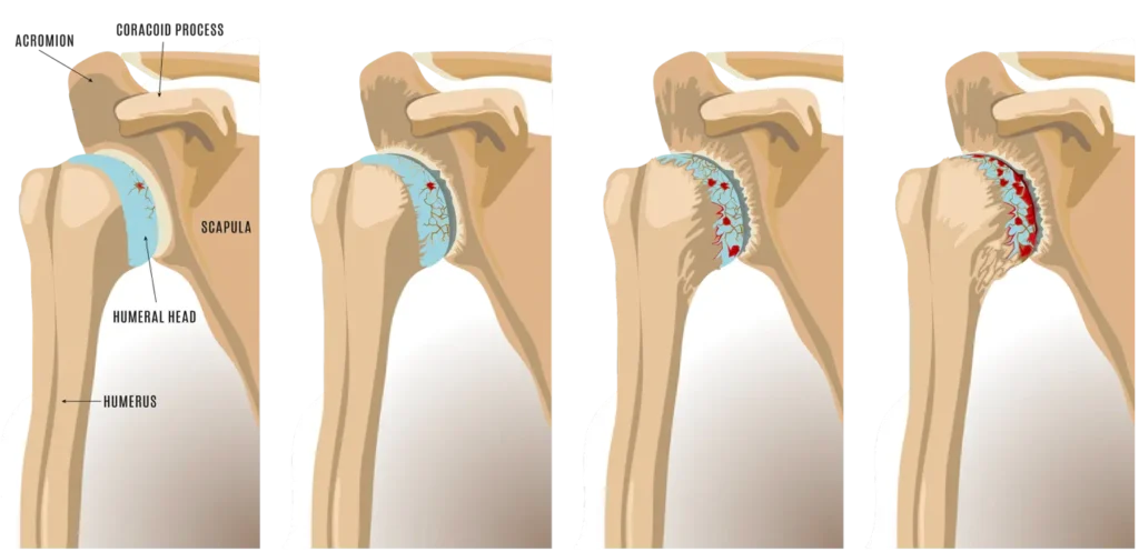 Arthritis progression in the shoulder