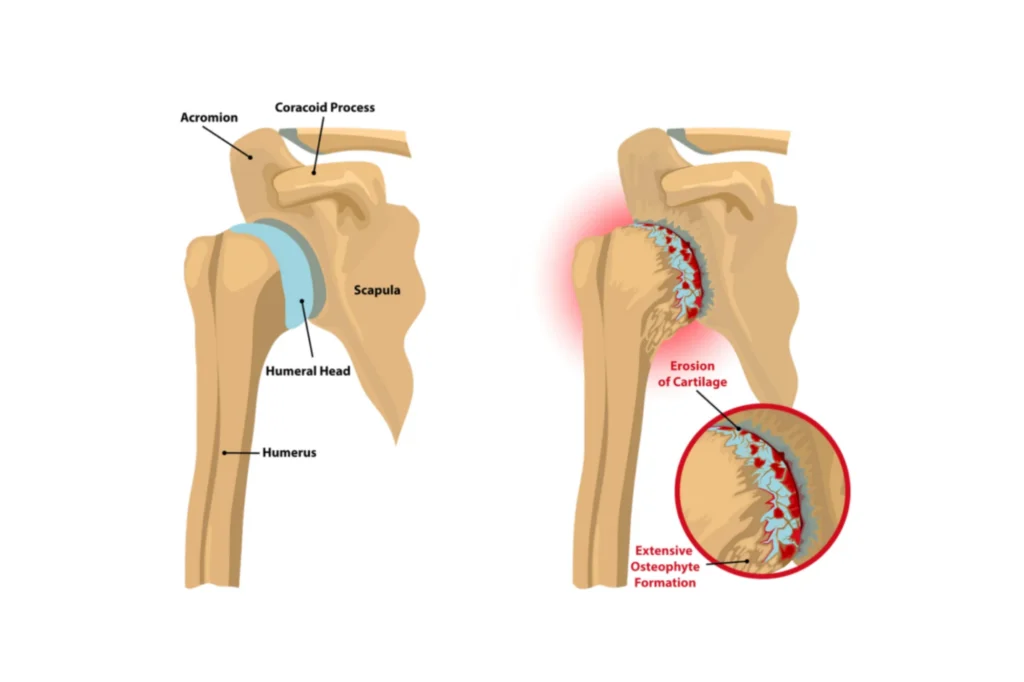 Shoulder Arthritis Anatomy