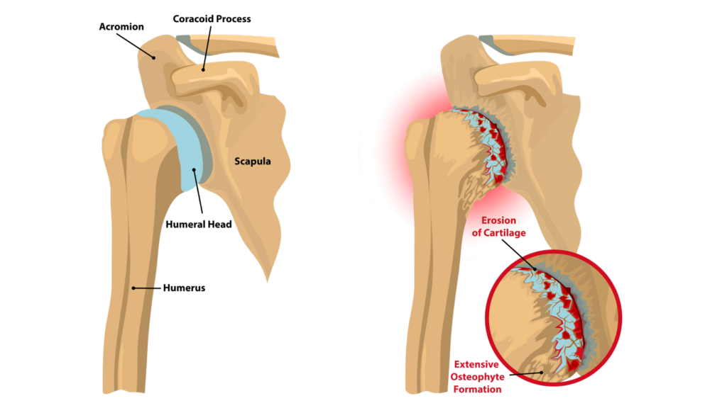 Post-traumatic Shoulder Arthritis