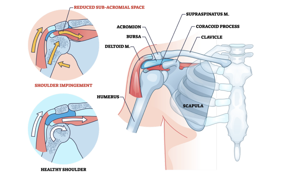 Shoulder Impingement Syndrome