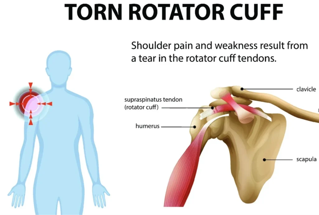 torn rotator cuff diagram torn rotator cuff diagram with a focus on the internal shoulder anatomy and where the pain is in the body.
