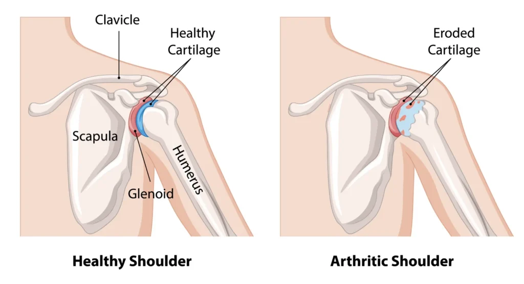 diagram of shoulder arthritis compared to a healthy shoulder