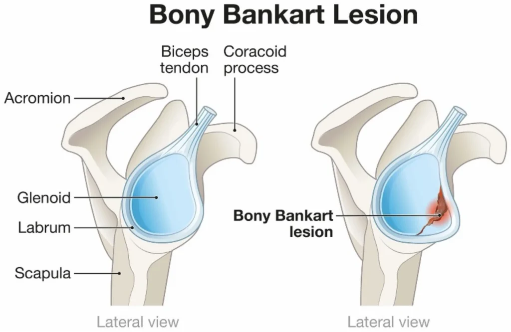 Bony bankart lesion diagram