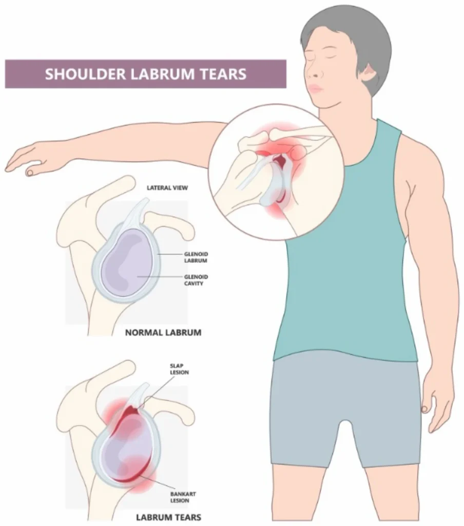 Shoulder labrum tear diagram 